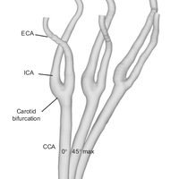 The role of the carotid sinus in the reduction of arterial wall stresses due to head movements – potential implications for cervical artery dissection