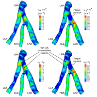 Patient-specific three-dimensional simulation of LDL accumulation in a human left coronary artery in its healthy and atherosclerotic states