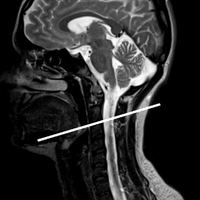 Continuous positive airway pressure alters cranial blood flow and cerebrospinal fluid dynamics at the craniovertebral junction