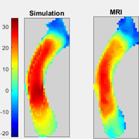 Virtual surgical planning, flow simulation and 3D electro-spinning of patient-specific grafts to optimize Fontan hemodynamics