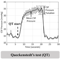 Queckenstedt’s test repurposed for the quantitative assessment of the cerebrospinal fluid pulsatility curve